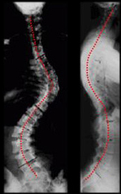 scoliosis san antonio, scoliosis surgery san antonio, scoliosis surgeon san antonio, treatment options for scoliosis, nonsurgical treatment, surgical treatment texas, austin, houston, waco,scoliosis austin,scoliosis houston,scoliosis waco,scoliosis surgery austin,scoliosis surgery houston,scoliosis surgery waco, minimally invasive scoliosis surgery texas, minimally invasive scoliosis surgery Austin, back pain treatment Austin, Scoliosis second opinion Austin, Flatback syndrome Austin, Scoliosis second opinion Texas, Flatback syndrome Texas, mini scoliosis surgery Texas, back pain Austin, neck pain Austin, spine surgery Austin, spine care Austin, spine surgeon Austin, scoliosis surgery waco, scoliosis treatment in texas, Scoliosis treatment in Louisiana, scoliosis doctor Austin, pediatric scoliosis surgeon texas, who is the best surgeon for scoliosis correction Texas, specialist in scoliosis Texas, scoliosis and spine surgery waco, degenerative scoliosis treatment in texas, scoliosis doctor austin texas, pediatric scoliosis surgeon in texas