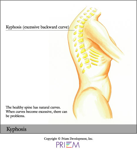 Kyphosis, minimally invasive scoliosis surgery texas, minimally invasive scoliosis surgery Austin, back pain treatment Austin, Scoliosis second opinion Austin, Flatback syndrome Austin, Scoliosis second opinion Texas, Flatback syndrome Texas, mini scoliosis surgery Texas, back pain Austin, neck pain Austin, spine surgery Austin, spine care Austin, spine surgeon Austin, scoliosis surgery waco, scoliosis treatment in texas, Scoliosis treatment in Louisiana, scoliosis doctor Austin, pediatric scoliosis surgeon texas, who is the best surgeon for scoliosis correction Texas, specialist in scoliosis Texas, scoliosis and spine surgery waco, degenerative scoliosis treatment in texas, scoliosis doctor austin texas, pediatric scoliosis surgeon in texas