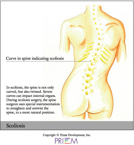 curved spine