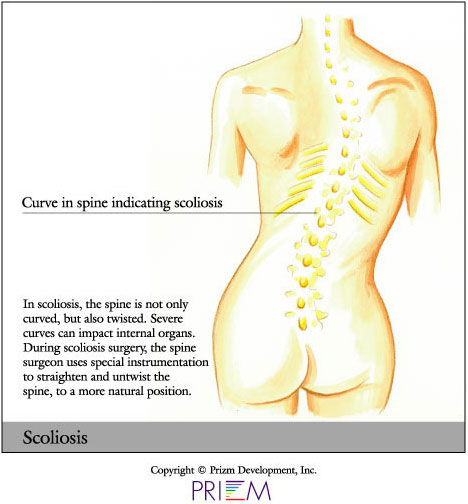 Back and Neck Braces  Used for Scoliosis and Spine Disorders