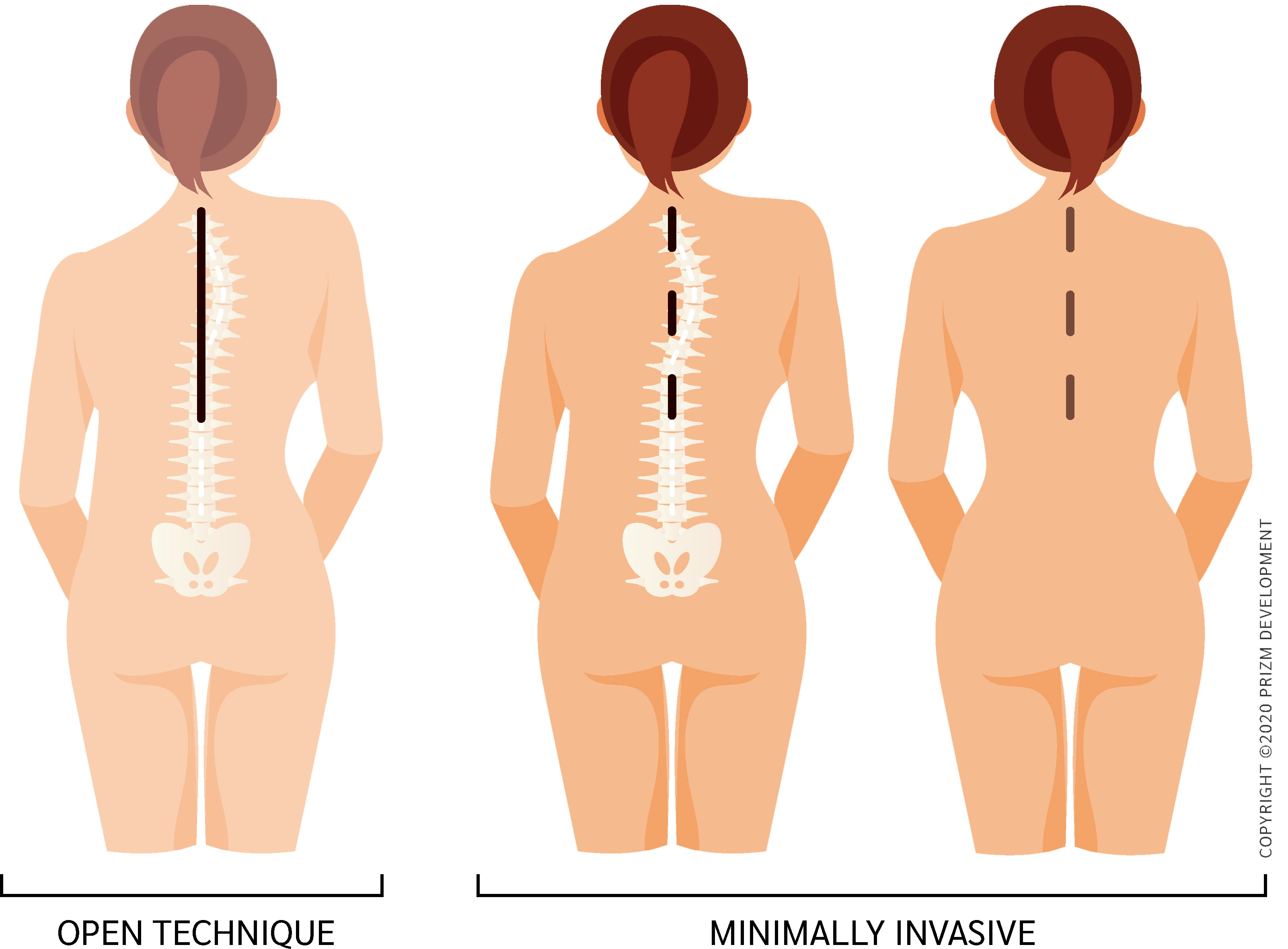 scoliosis treatment options