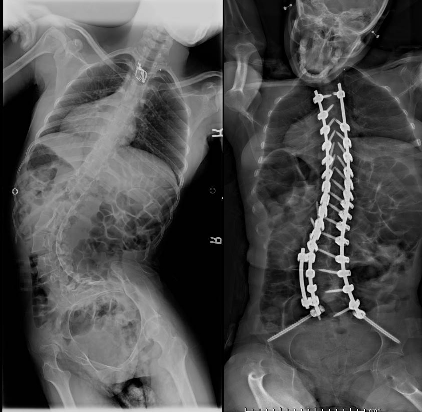 Neuromuscular Scoliosis Scoliosis Texas