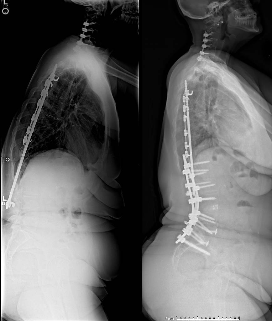 Scoliosis Surgery Rods