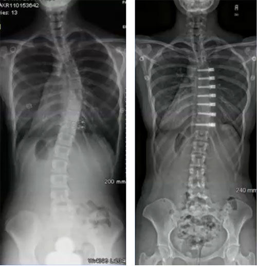 Scoliosis Braces: Are They Outdated & Ineffective