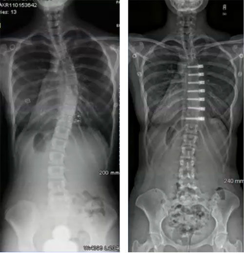 Operate Now: Scoliosis Surgery 