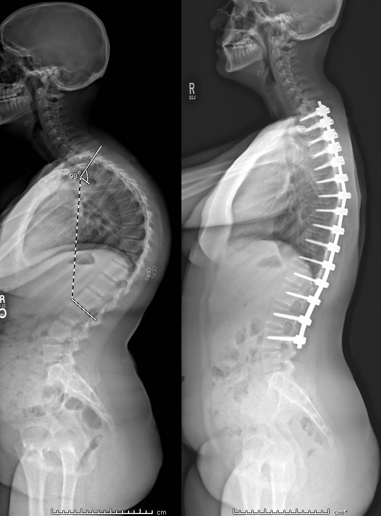 Lumbar Spinal Bracing, Non-Surgical Scheuermann's Kyphosis