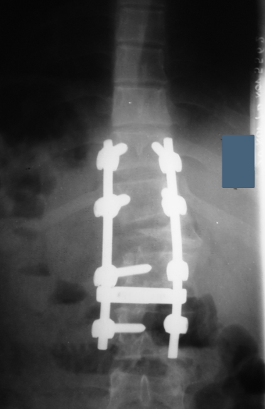 scoliosis and kyphosis treatment for child - dr matthew geck texas scoliosis surgeon, new mexico scoliosis surgeon, louisiana scoliosis surgeon