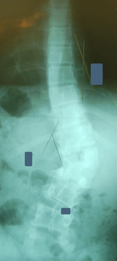 scoliosis and kyphosis treatment for child - dr matthew geck texas scoliosis surgeon, new mexico scoliosis surgeon, louisiana scoliosis surgeon, minimally invasive scoliosis surgery texas, minimally invasive scoliosis surgery Austin, back pain treatment Austin, Scoliosis second opinion Austin, Flatback syndrome Austin, Scoliosis second opinion Texas, Flatback syndrome Texas, mini scoliosis surgery Texas, back pain Austin, neck pain Austin, spine surgery Austin, spine care Austin, spine surgeon Austin, scoliosis surgery waco, scoliosis treatment in texas, Scoliosis treatment in Louisiana, scoliosis doctor Austin, pediatric scoliosis surgeon texas, who is the best surgeon for scoliosis correction Texas, specialist in scoliosis Texas, scoliosis and spine surgery waco, degenerative scoliosis treatment in texas, scoliosis doctor austin texas, pediatric scoliosis surgeon in texas