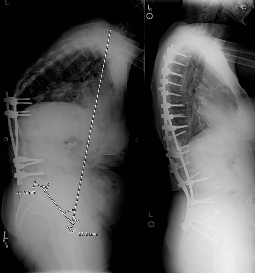 Operate Now: Scoliosis Surgery 