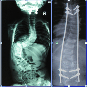 scoliosis surgery austin, scoliosis surgery houston, scoliosis surgery san antonio, scoliosis treatment for children with 120 degree scoliosis - dr matthew geck texas scoliosis surgeon, dallas scoliosis surgeon, houston scoliosis surgeon, austin scoliosis surgeon