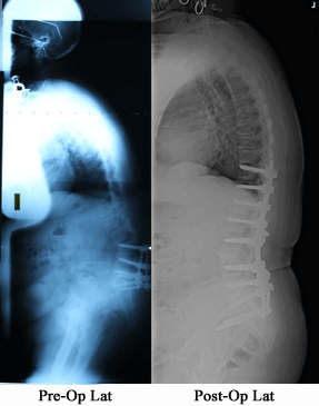 pedicle subtraction osteotomy - flatback syndrome, kyphosis, dr matthew geck, austin texas,pediatric scoliosis austin,pediatric scoliosis houston,pediatric scoliosis waco,pediatric scoliosis temple, minimally invasive scoliosis surgery texas, minimally invasive scoliosis surgery Austin, back pain treatment Austin, Scoliosis second opinion Austin, Flatback syndrome Austin, Scoliosis second opinion Texas, Flatback syndrome Texas, mini scoliosis surgery Texas, back pain Austin, neck pain Austin, spine surgery Austin, spine care Austin, spine surgeon Austin, scoliosis surgery waco, scoliosis treatment in texas, Scoliosis treatment in Louisiana, scoliosis doctor Austin, pediatric scoliosis surgeon texas, who is the best surgeon for scoliosis correction Texas, specialist in scoliosis Texas, scoliosis and spine surgery waco, degenerative scoliosis treatment in texas, scoliosis doctor austin texas, pediatric scoliosis surgeon in texas