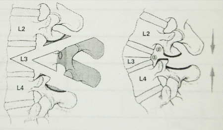 diagram for Pedicle subtraction osteotomy (PSO), an effective tool for the correction of Adult Kyphosis, minimally invasive scoliosis surgery texas, minimally invasive scoliosis surgery Austin, back pain treatment Austin, Scoliosis second opinion Austin, Flatback syndrome Austin, Scoliosis second opinion Texas, Flatback syndrome Texas, mini scoliosis surgery Texas, back pain Austin, neck pain Austin, spine surgery Austin, spine care Austin, spine surgeon Austin, scoliosis surgery waco, scoliosis treatment in texas, Scoliosis treatment in Louisiana, scoliosis doctor Austin, pediatric scoliosis surgeon texas, who is the best surgeon for scoliosis correction Texas, specialist in scoliosis Texas, scoliosis and spine surgery waco, degenerative scoliosis treatment in texas, scoliosis doctor austin texas, pediatric scoliosis surgeon in texas