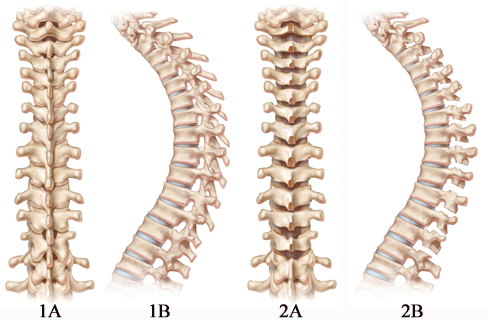 image 1 of Ponte procedure, a less invasive, single approach to Scheuermann's Kyphosis or Severe Scoliosis, Dr. Geck specializes in scoliosis and complex spine surgery in Central Texas including Austin, Houston and Waco, New Mexico, Louisiana, minimally invasive scoliosis surgery texas, minimally invasive scoliosis surgery Austin, back pain treatment Austin, Scoliosis second opinion Austin, Flatback syndrome Austin, Scoliosis second opinion Texas, Flatback syndrome Texas, mini scoliosis surgery Texas, back pain Austin, neck pain Austin, spine surgery Austin, spine care Austin, spine surgeon Austin, scoliosis surgery waco, scoliosis treatment in texas, Scoliosis treatment in Louisiana, scoliosis doctor Austin, pediatric scoliosis surgeon texas, who is the best surgeon for scoliosis correction Texas, specialist in scoliosis Texas, scoliosis and spine surgery waco, degenerative scoliosis treatment in texas, scoliosis doctor austin texas, pediatric scoliosis surgeon in texas