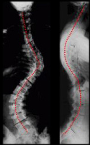 scoliosis san antonio, scoliosis treatment san antonio, scoliosis houston, scoliosis treatment austin,scoliosis treatment houston,scoliosis treatment waco,scoliosis surgery austin,scoliosis surgery houston,scoliosis surgery waco,information about Idiopathic Scoliosis provided by dr matthew geck in central texas, new mexico, louisiana, minimally invasive scoliosis surgery texas, minimally invasive scoliosis surgery Austin, back pain treatment Austin, Scoliosis second opinion Austin, Flatback syndrome Austin, Scoliosis second opinion Texas, Flatback syndrome Texas, mini scoliosis surgery Texas, back pain Austin, neck pain Austin, spine surgery Austin, spine care Austin, spine surgeon Austin, scoliosis surgery waco, scoliosis treatment in texas, Scoliosis treatment in Louisiana, scoliosis doctor Austin, pediatric scoliosis surgeon texas, who is the best surgeon for scoliosis correction Texas, specialist in scoliosis Texas, scoliosis and spine surgery waco, degenerative scoliosis treatment in texas, scoliosis doctor austin texas, pediatric scoliosis surgeon in texas