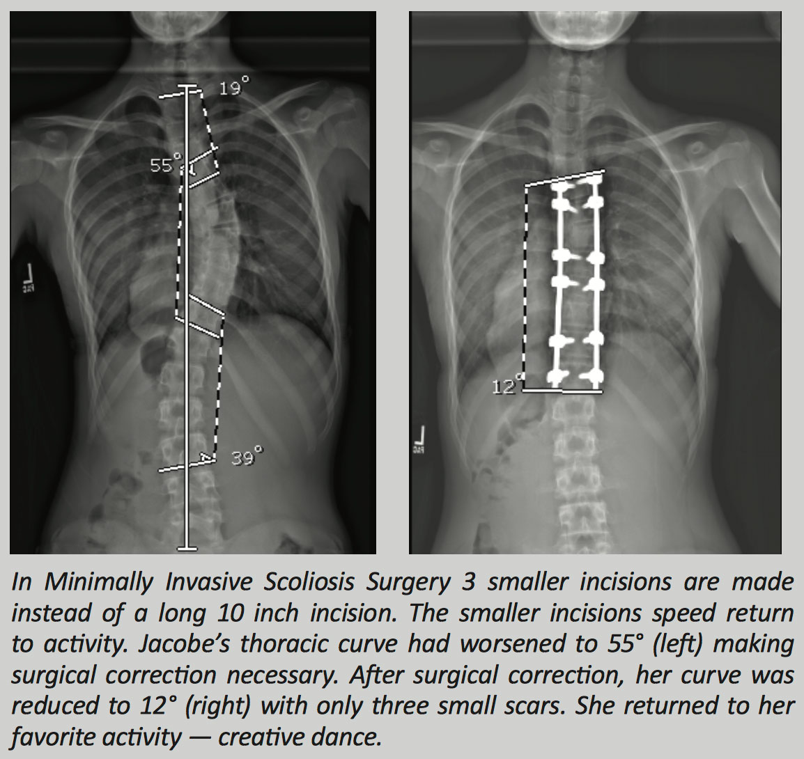 Scoliosis Correction Surgery