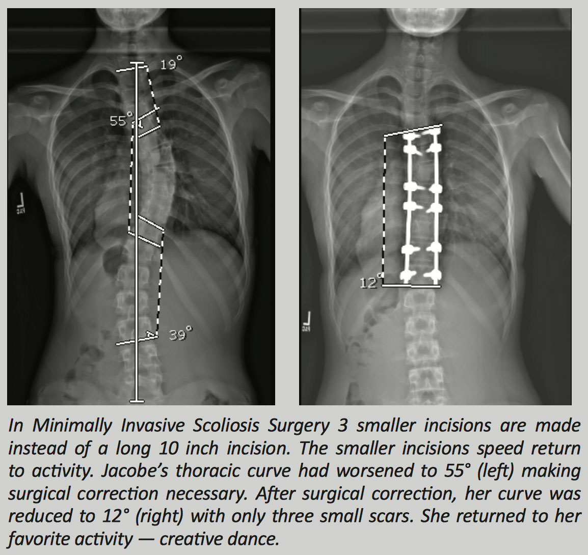 Scoliosis Surgery Scar Tattoos